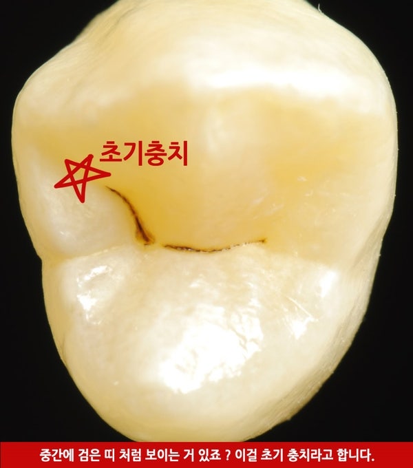 충치치료 ! 왜 누구는 하라고 하고 누구는 하지 말라고 하죠 ?충치초기치료는 어떻게 ? 사진 2