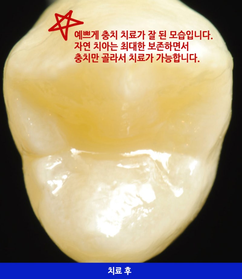 충치치료 ! 왜 누구는 하라고 하고 누구는 하지 말라고 하죠 ?충치초기치료는 어떻게 ? 사진 12
