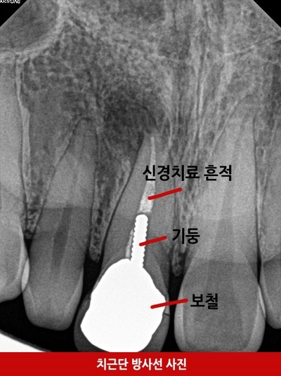 충치치료 ! 왜 누구는 하라고 하고 누구는 하지 말라고 하죠 ?충치초기치료는 어떻게 ? 사진 7