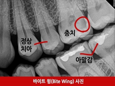 충치치료 ! 왜 누구는 하라고 하고 누구는 하지 말라고 하죠 ?충치초기치료는 어떻게 ?