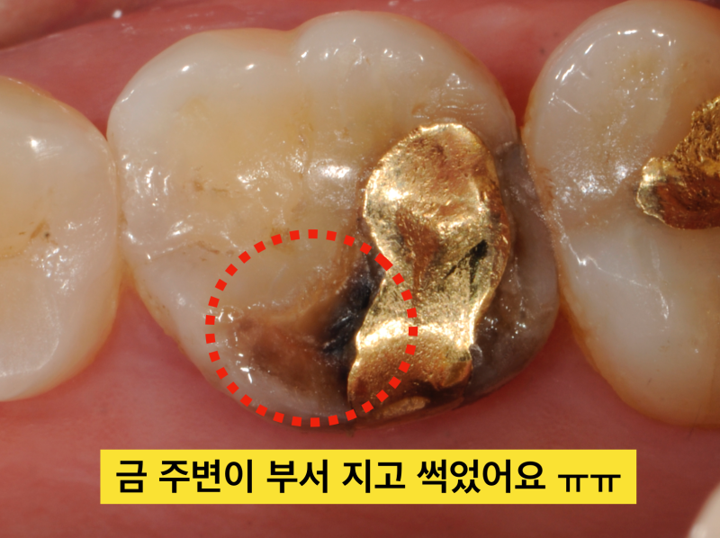 [의사솔직발언] 치아충치치료, 보철 치료시(인레이나 크라운) 금이냐 세라믹이냐 ? 사진 3