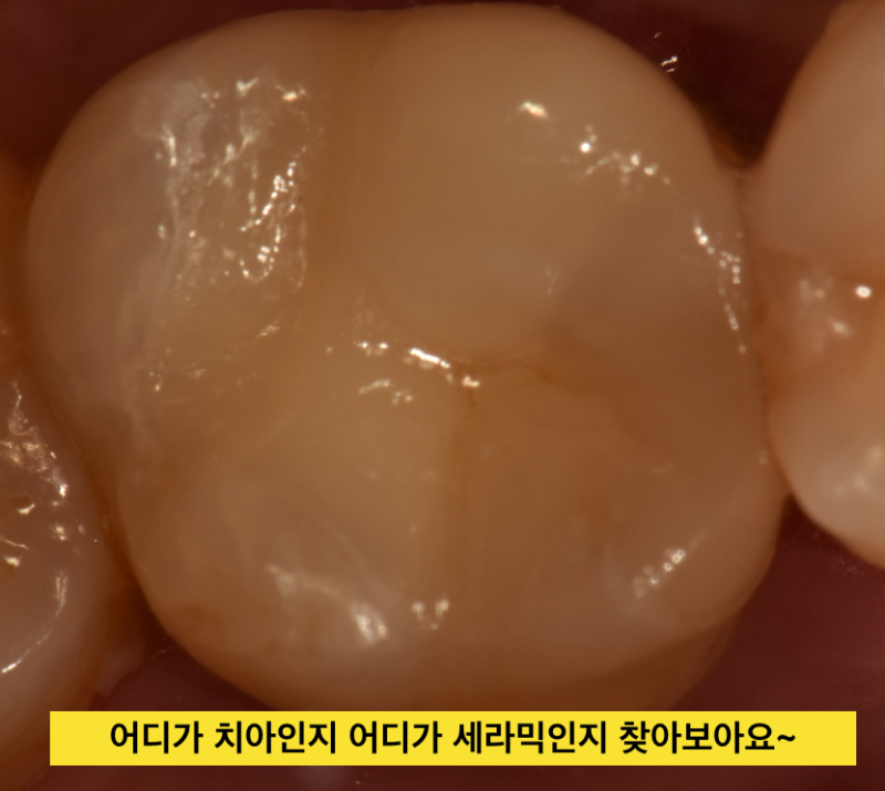 [의사솔직발언] 치아충치치료, 보철 치료시(인레이나 크라운) 금이냐 세라믹이냐 ? 사진 5