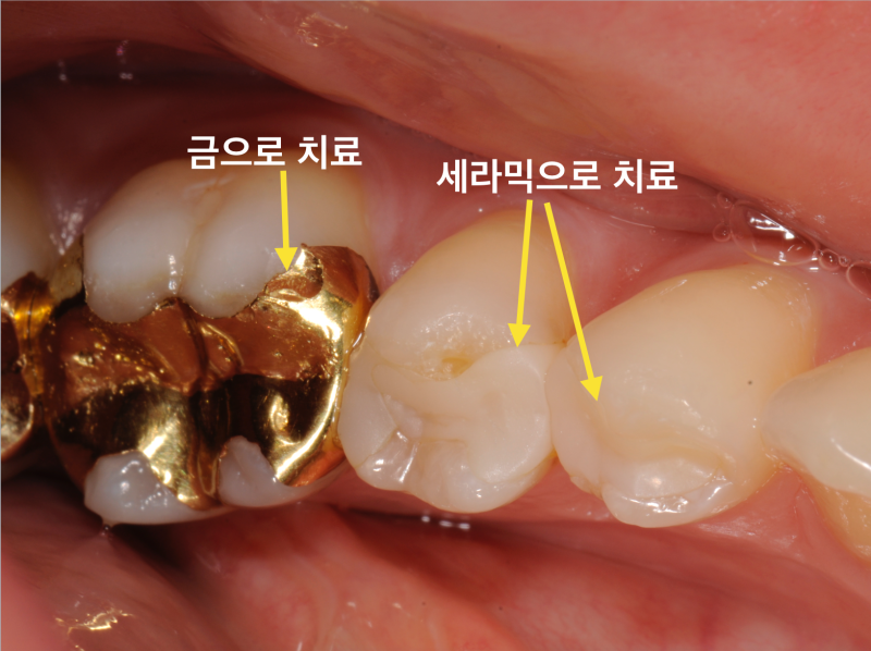 [의사솔직발언] 치아충치치료, 보철 치료시(인레이나 크라운) 금이냐 세라믹이냐 ?