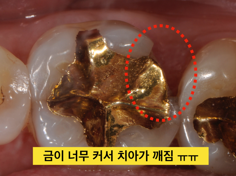 [의사솔직발언] 치아충치치료, 보철 치료시(인레이나 크라운) 금이냐 세라믹이냐 ? 사진 4