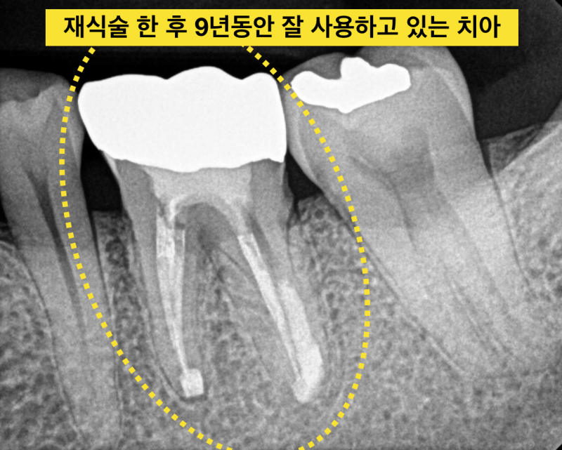 [임플란트안하면 ?] 임플란트안하고 자연치아살리기_치아재식술, 의도적재식술 사진 12