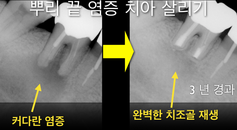 [임플란트안하면 ?] 임플란트안하고 자연치아살리기_치아재식술, 의도적재식술