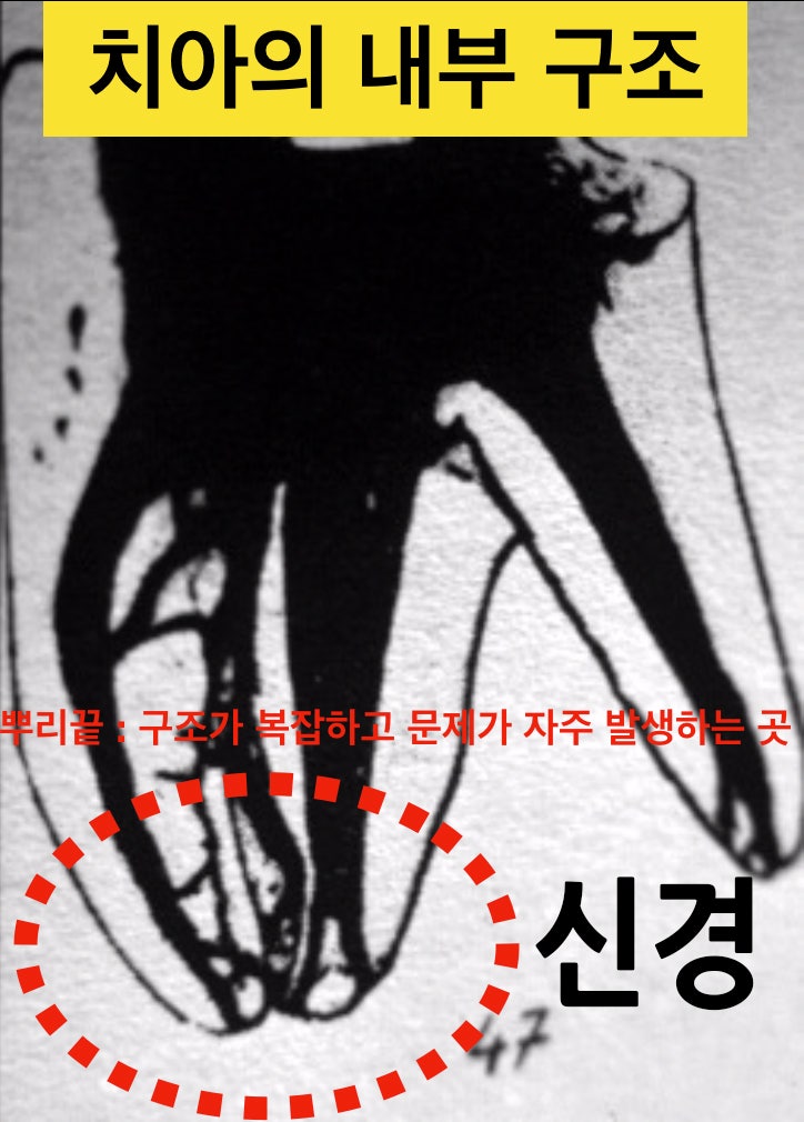[임플란트안하면 ?] 임플란트안하고 자연치아살리기_치아재식술, 의도적재식술 사진 2