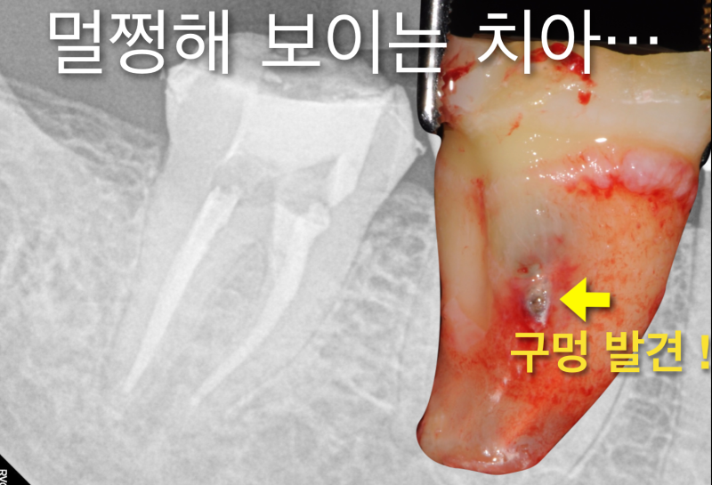 [임플란트안하면 ?] 임플란트안하고 자연치아살리기_치아재식술, 의도적재식술 사진 6