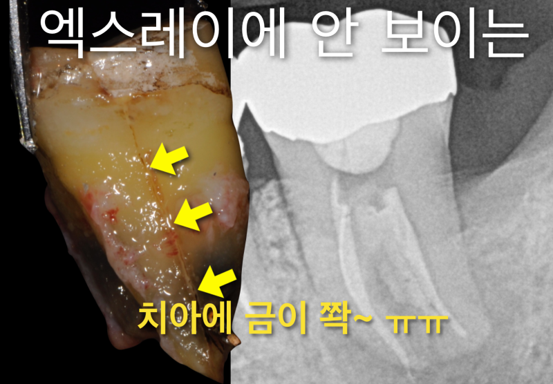 [임플란트안하면 ?] 임플란트안하고 자연치아살리기_치아재식술, 의도적재식술 사진 7