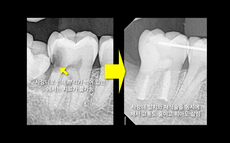 [임플란트안하면 ?] 임플란트안하고 자연치아살리기_치아재식술, 의도적재식술 사진 10