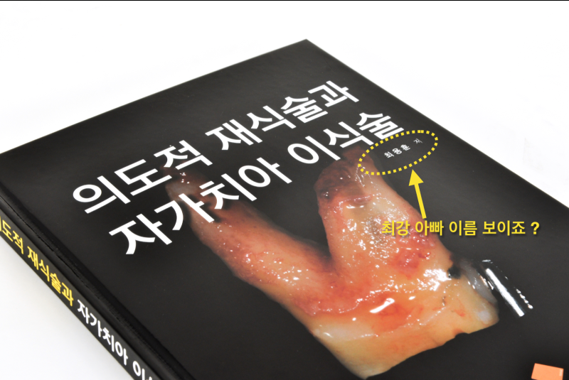 [임플란트안하면 ?] 임플란트안하고 자연치아살리기_치아재식술, 의도적재식술 사진 11