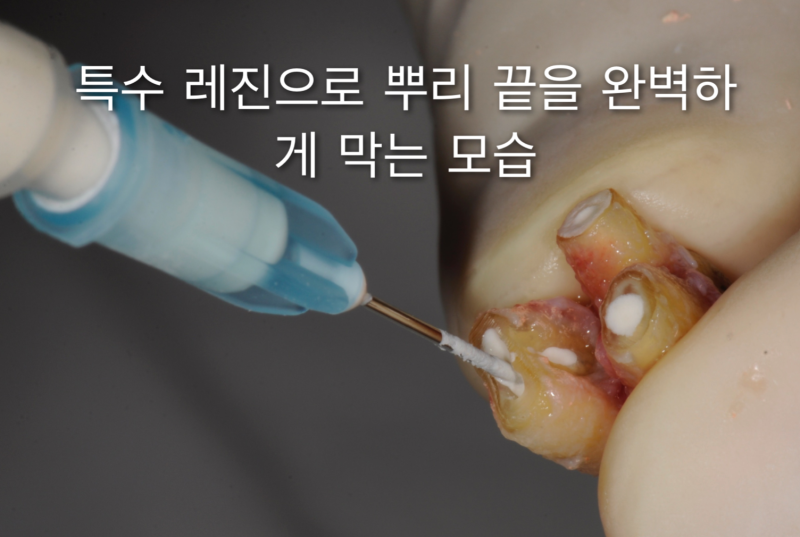 [임플란트안하면 ?] 임플란트안하고 자연치아살리기_치아재식술, 의도적재식술 사진 8