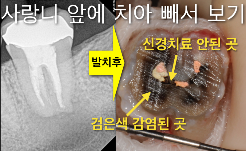 [임플란트안하면 ?] 임플란트안하고 자연치아살리기_치아재식술, 의도적재식술 사진 5