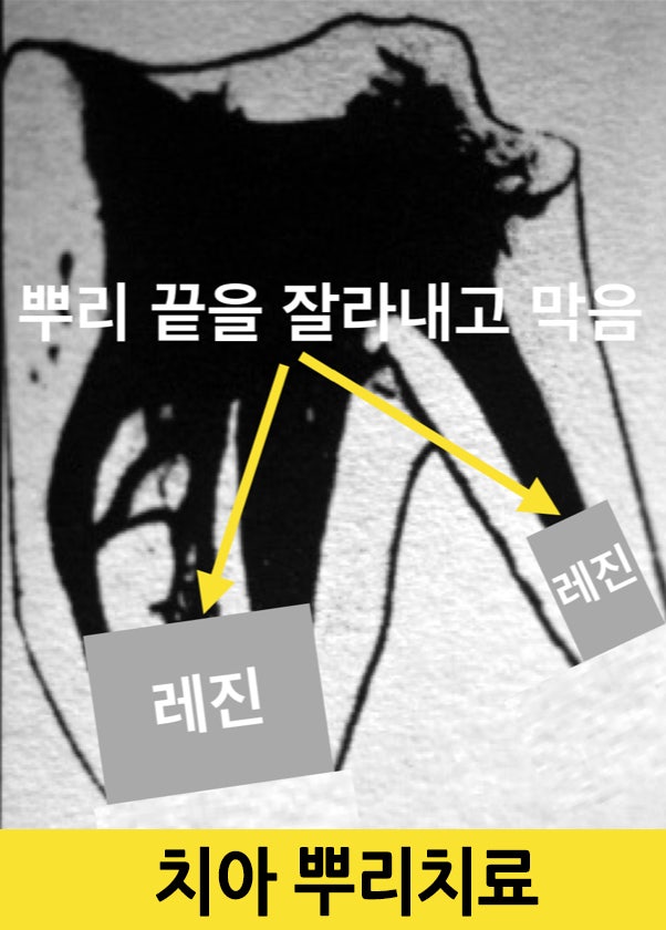[임플란트안하면 ?] 임플란트안하고 자연치아살리기_치아재식술, 의도적재식술 사진 3