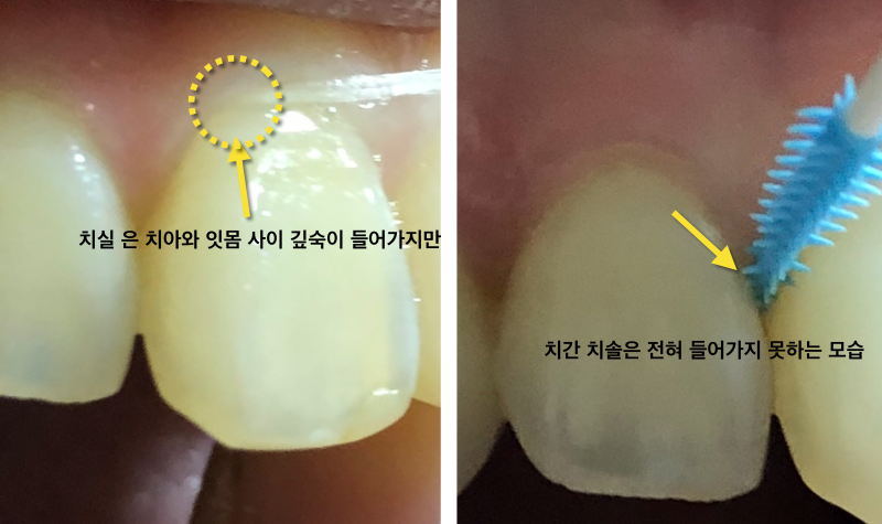 치간칫솔, 치실효과 있나요 ? 치간칫솔과치실의차이_치실사용법,치간칫솔사용법