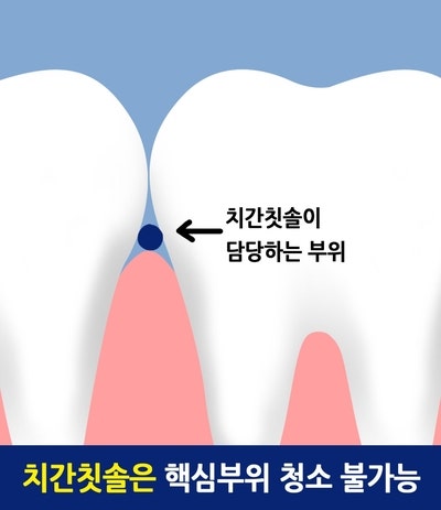 치간칫솔, 치실효과 있나요 ? 치간칫솔과치실의차이_치실사용법,치간칫솔사용법 사진 3