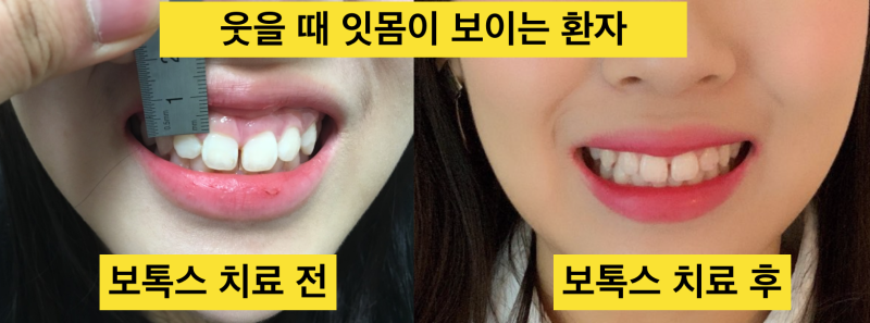 치아파절 예방! 나는 보톡스가 필요한가?치아깨짐! 그전에 예방하자_치과보톡스 사진 7