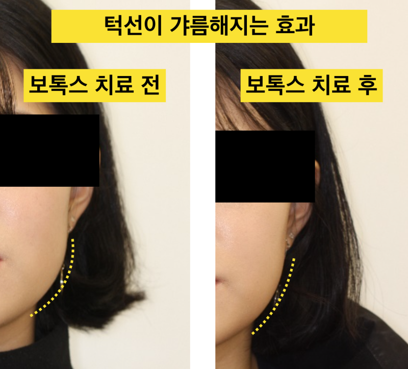 치아파절 예방! 나는 보톡스가 필요한가?치아깨짐! 그전에 예방하자_치과보톡스 사진 6