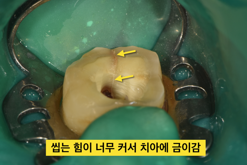 치아파절 예방! 나는 보톡스가 필요한가?치아깨짐! 그전에 예방하자_치과보톡스