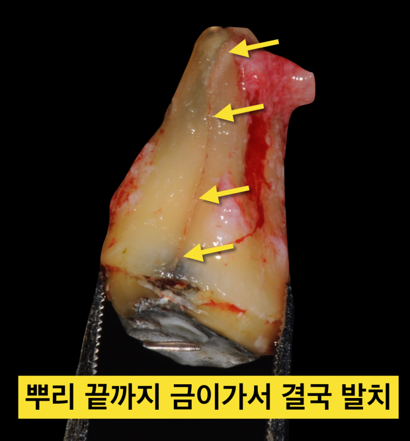 치아파절 예방! 나는 보톡스가 필요한가?치아깨짐! 그전에 예방하자_치과보톡스 사진 3