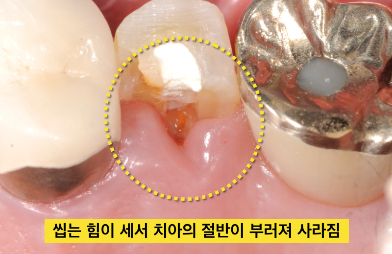 치아파절 예방! 나는 보톡스가 필요한가?치아깨짐! 그전에 예방하자_치과보톡스
