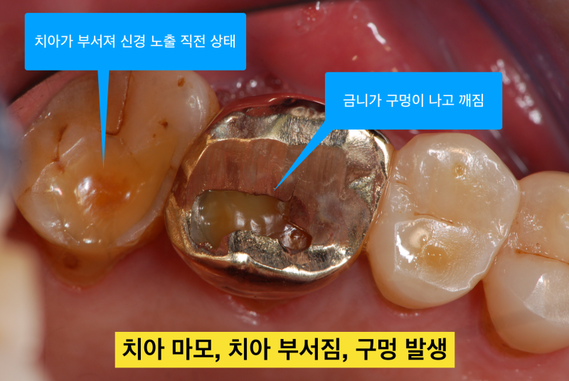 치아파절 예방! 나는 보톡스가 필요한가?치아깨짐! 그전에 예방하자_치과보톡스 사진 4