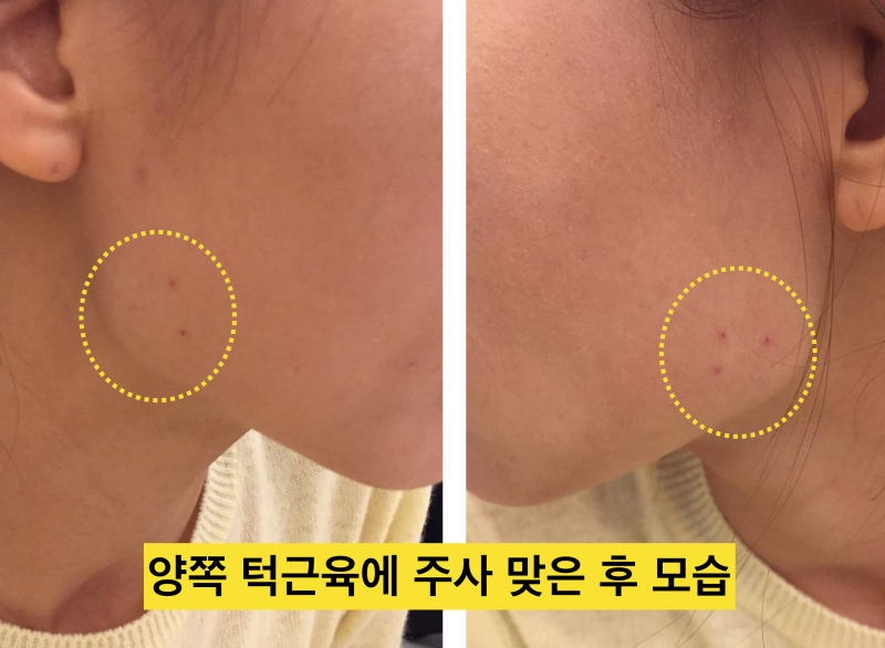 치아파절 예방! 나는 보톡스가 필요한가?치아깨짐! 그전에 예방하자_치과보톡스 사진 5