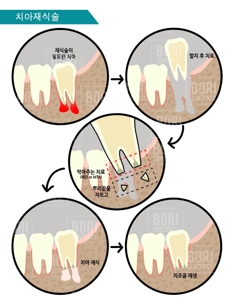 치아재식술_당서울대병원 치과 최용훈교수, 임플란트 하기 전에 꼭 확인해야할 의도적 재식술 1탄 사진 3