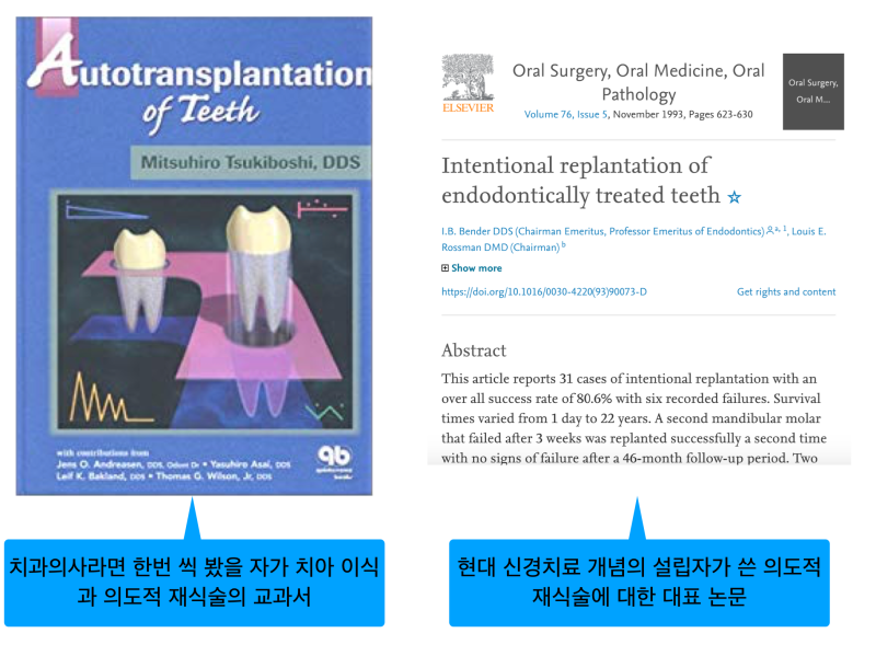 치아재식술_당서울대병원 치과 최용훈교수, 임플란트 하기 전에 꼭 확인해야할 의도적 재식술 1탄 사진 4