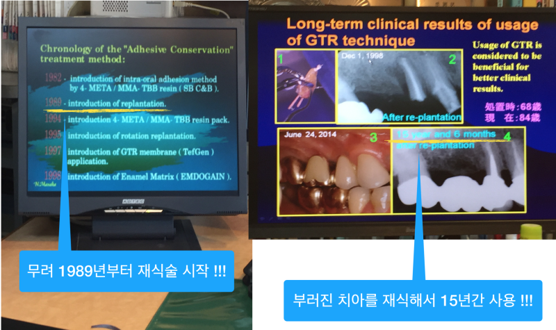치아재식술_당서울대병원 치과 최용훈교수, 임플란트 하기 전에 꼭 확인해야할 의도적 재식술 1탄 사진 6