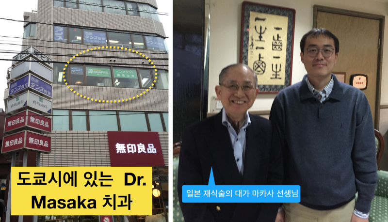 치아재식술_당서울대병원 치과 최용훈교수, 임플란트 하기 전에 꼭 확인해야할 의도적 재식술 1탄 사진 5
