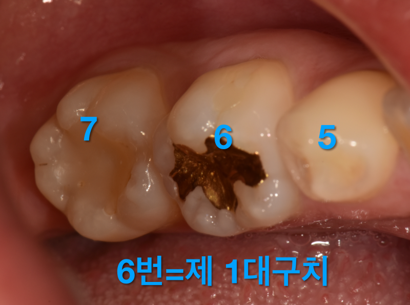 치과에서 호갱 NONO! 치아번호 알고가서 꼼꼼하게 치과진료받기 사진 6
