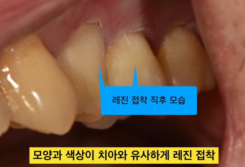 [치경부마모증/잇몸 떼우기] 잇몸 떼운것 자꾸 떨어져요. 치경부 레진 실패 이유와 해결방안 사진 8