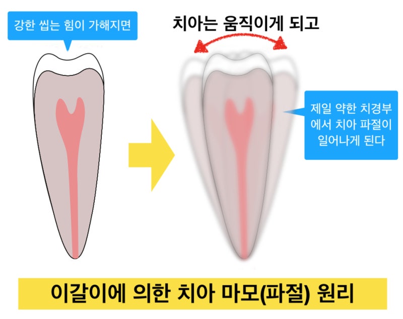 [치경부마모증/잇몸 떼우기] 잇몸 떼운것 자꾸 떨어져요. 치경부 레진 실패 이유와 해결방안 사진 2