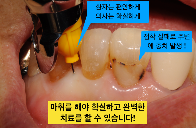 [치경부마모증/잇몸 떼우기] 잇몸 떼운것 자꾸 떨어져요. 치경부 레진 실패 이유와 해결방안