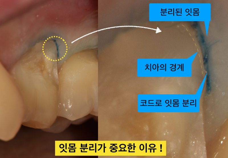 [치경부마모증/잇몸 떼우기] 잇몸 떼운것 자꾸 떨어져요. 치경부 레진 실패 이유와 해결방안 사진 6