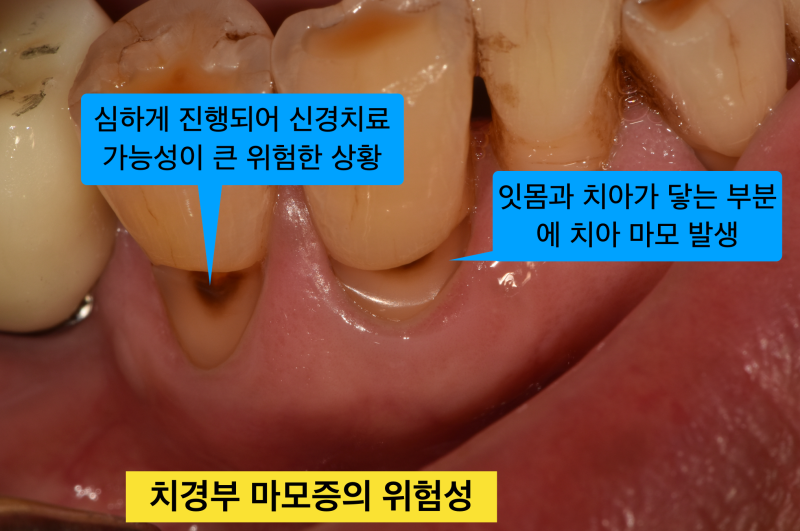 [치경부마모증/잇몸 떼우기] 잇몸 떼운것 자꾸 떨어져요. 치경부 레진 실패 이유와 해결방안