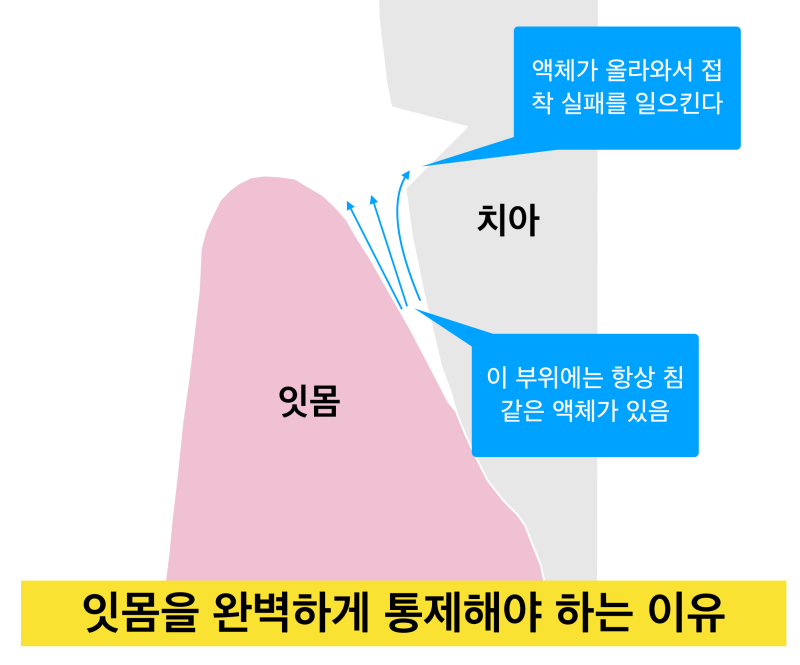 [치경부마모증/잇몸 떼우기] 잇몸 떼운것 자꾸 떨어져요. 치경부 레진 실패 이유와 해결방안 사진 5