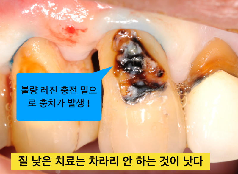 [치경부마모증/잇몸 떼우기] 잇몸 떼운것 자꾸 떨어져요. 치경부 레진 실패 이유와 해결방안 사진 4
