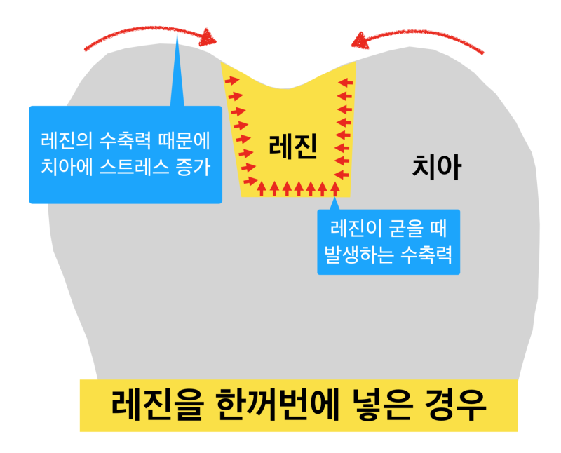[극심한 치아통증] 치과 치료 후 통증, 치과 레진 치료후 통증이유! 치료 후 통증이 생기는 이유 사진 4