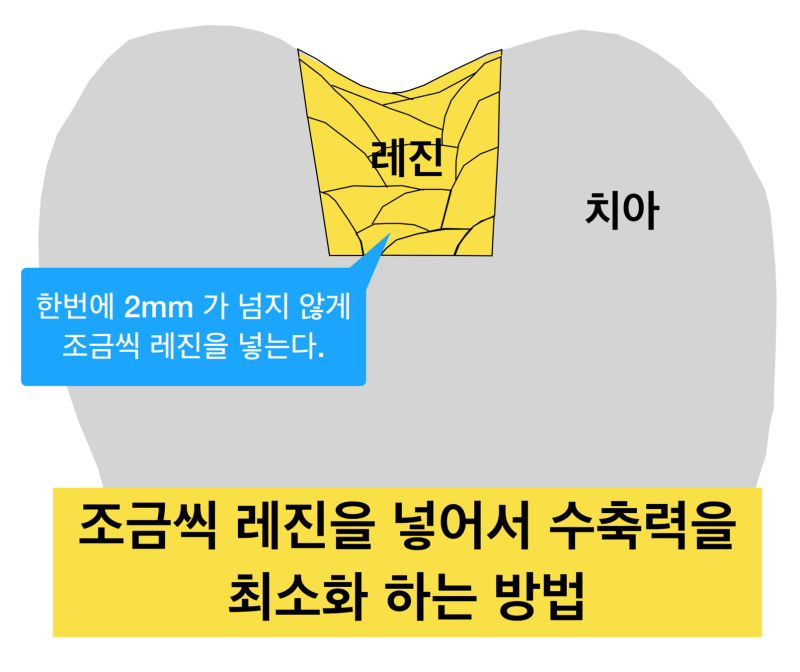 [극심한 치아통증] 치과 치료 후 통증, 치과 레진 치료후 통증이유! 치료 후 통증이 생기는 이유 사진 5
