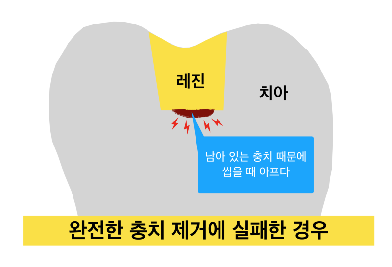 [극심한 치아통증] 치과 치료 후  통증, 치과 레진 치료후 통증이유! 치료 후 통증이 생기는 이유