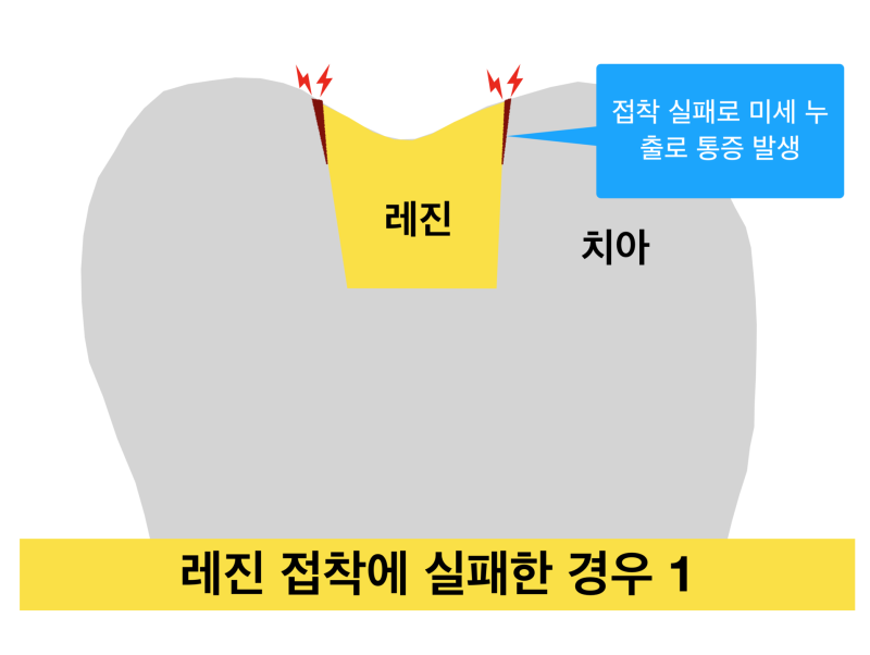 [극심한 치아통증] 치과 치료 후 통증, 치과 레진 치료후 통증이유! 치료 후 통증이 생기는 이유 사진 2