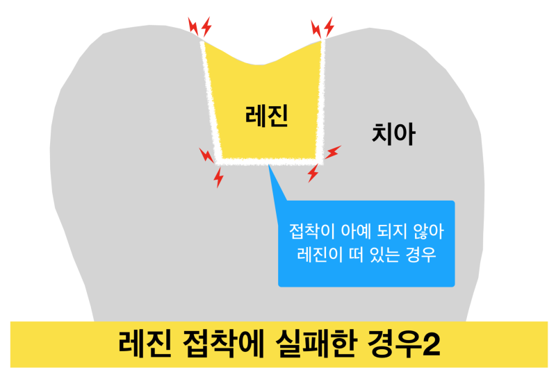 [극심한 치아통증] 치과 치료 후 통증, 치과 레진 치료후 통증이유! 치료 후 통증이 생기는 이유 사진 3