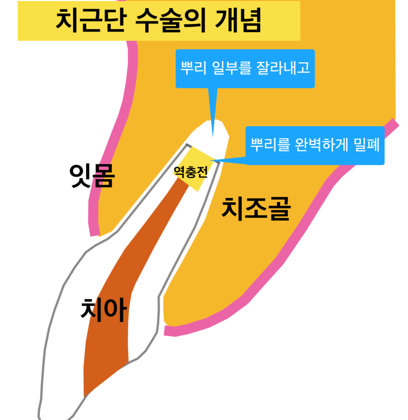 잇몸고름 생기는 이유, 잇몸고름 치료! 치근단 수술(치근단 절제술)이란 ? 사진 4