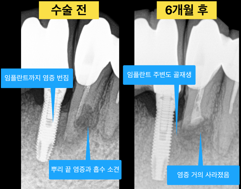 잇몸고름 생기는 이유, 잇몸고름 치료! 치근단 수술(치근단 절제술)이란 ? 사진 5