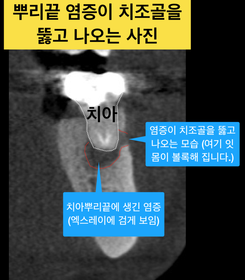 잇몸고름 생기는 이유, 잇몸고름 치료! 치근단 수술(치근단 절제술)이란 ? 사진 3