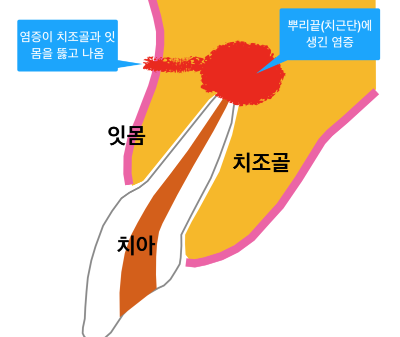 잇몸고름 생기는 이유, 잇몸고름 치료! 치근단 수술(치근단 절제술)이란 ? 사진 2