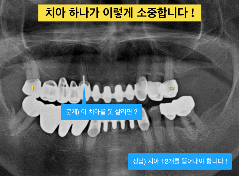 잇몸고름 생기는 이유, 잇몸고름 치료! 치근단 수술(치근단 절제술)이란 ?