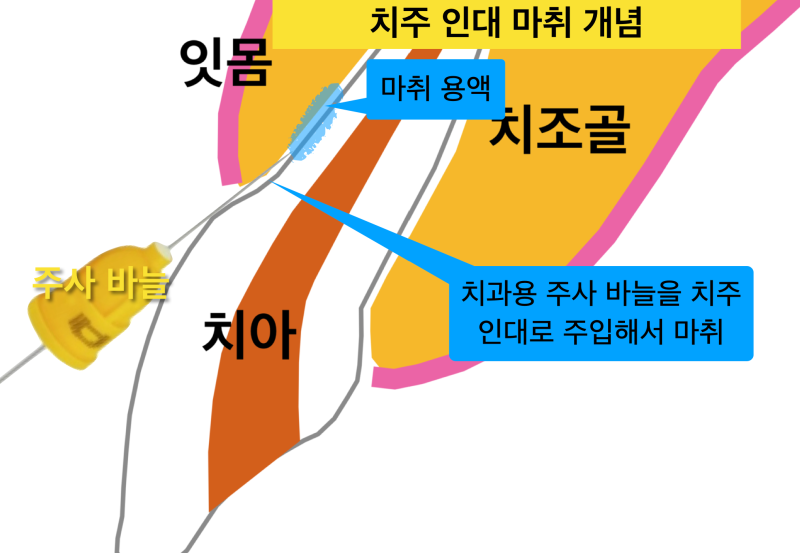 치과마취 안아프게 치료받는 꿀팁! 치과마취통증 없이~ 치주인대마취 알고가기